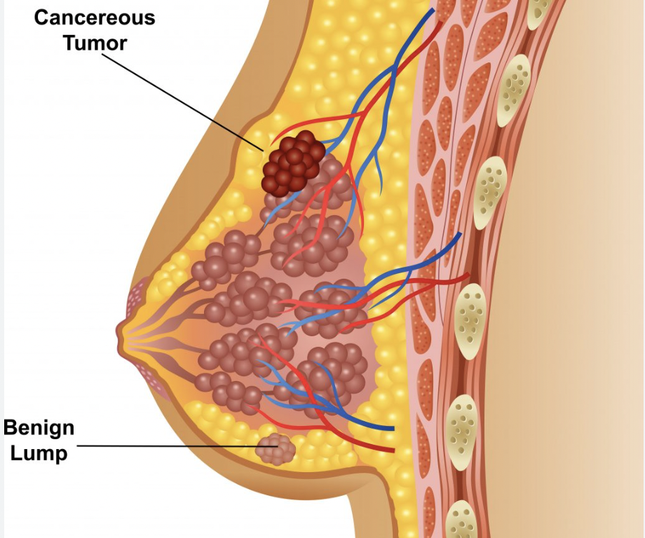 Breast lump surgery