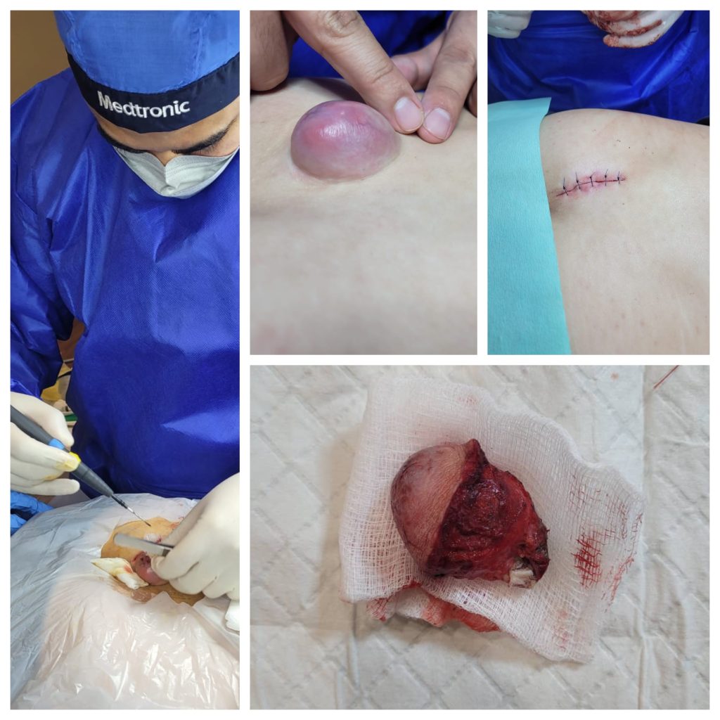 Excision of lower back sebaceous cyst