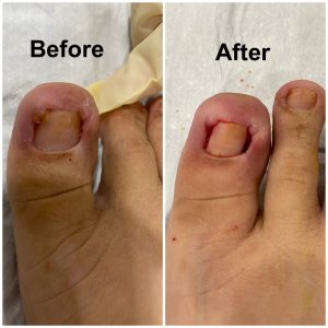 Partial Nail Removal on both sides