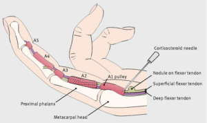 Trigger Finger Injection