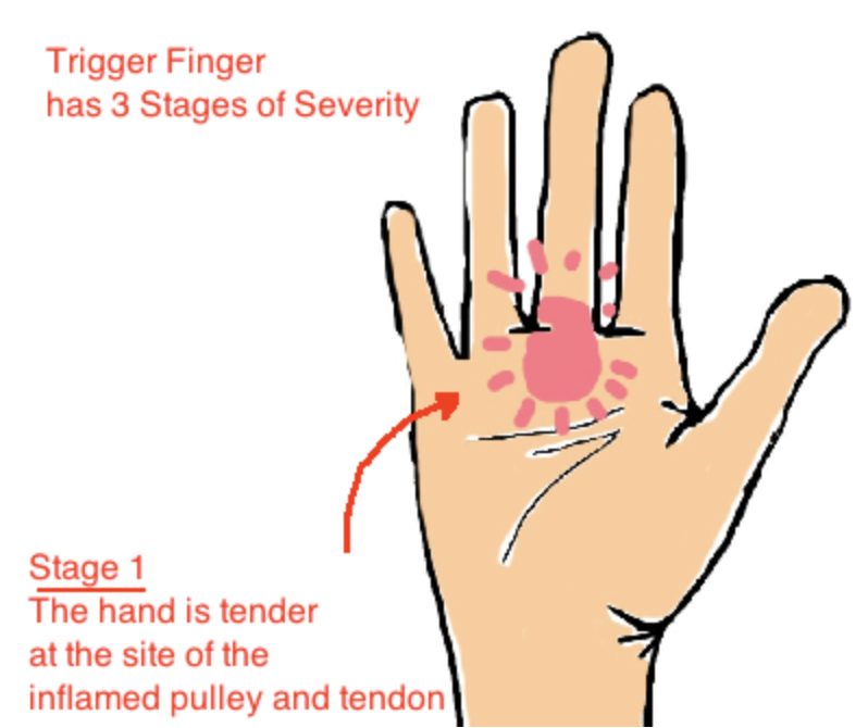 Stage 1 Trigger Finger