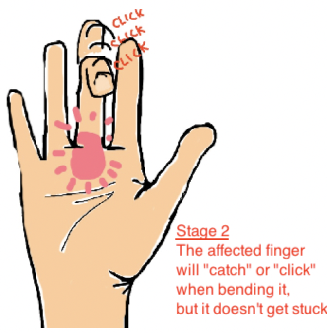 Stage 2 Trigger Finger