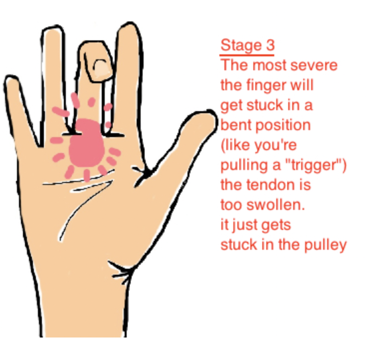 Stage 3 Trigger Finger