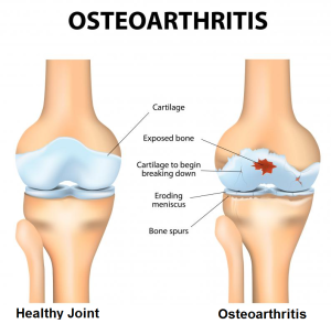 Osteoarthritis