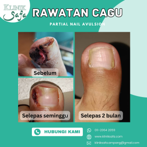 Ingrown toenail