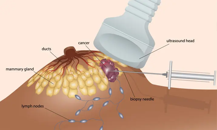 Breast tissue biopsy