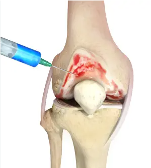 Hyaluronic Injection into the knee joint to treat osteoarthritis