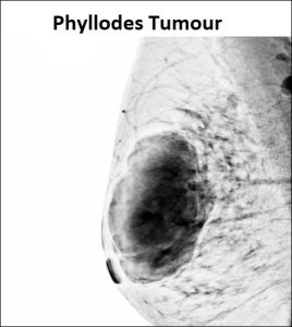 Treatment of Phyllodes tumour