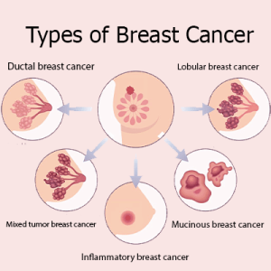 Treatment of breast cancer