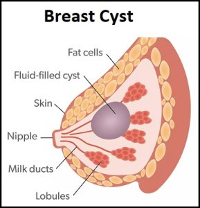 breast cyst treatment at Klinik Safa