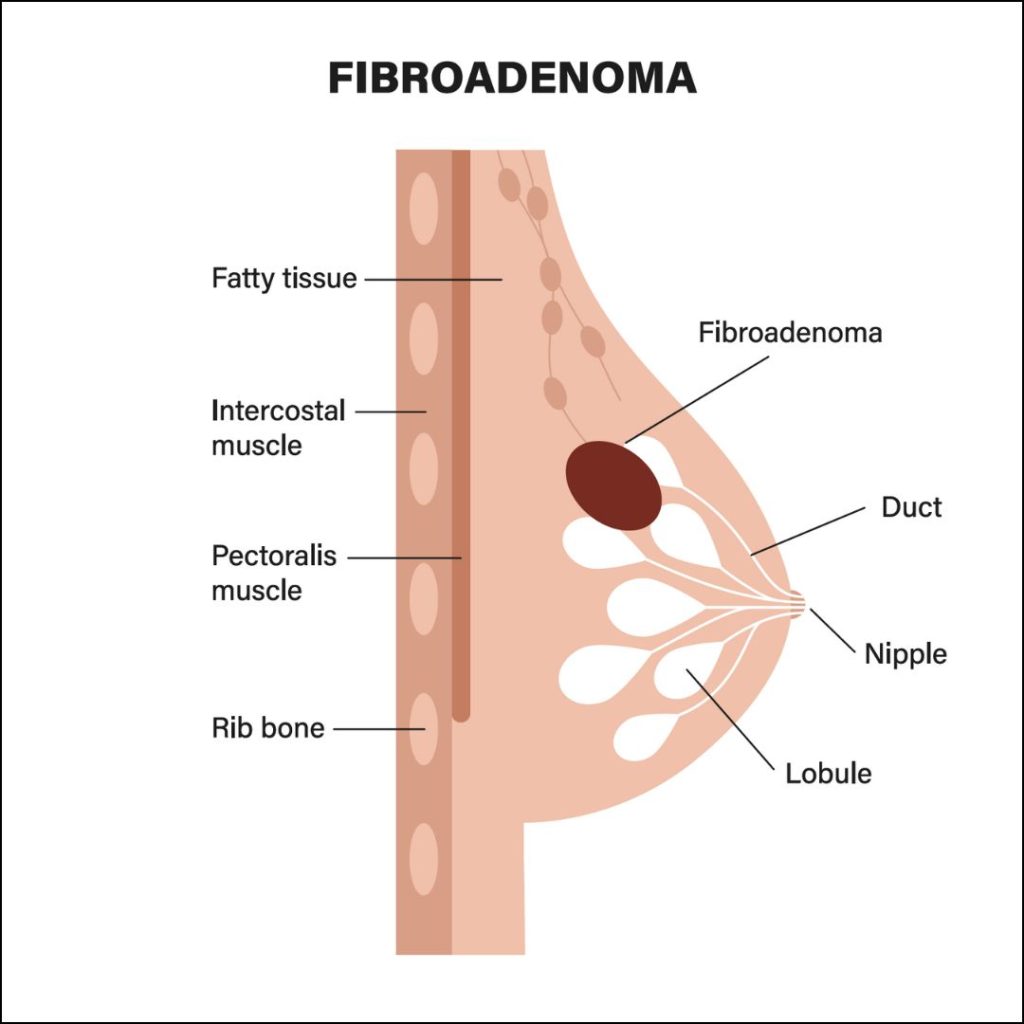 Fibroadenoma treatment at Klinik Safa