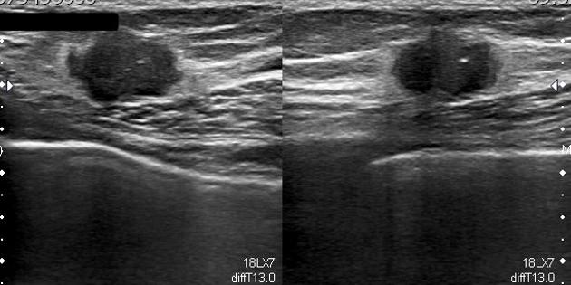 ultrasound breast lump